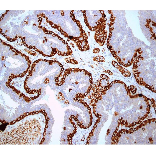 출처:&nbsp;https://cancerquest.org/patients/detection-and-diagnosis/immunohistochemistry-ihc