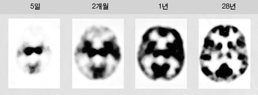 1년 과 28년 후를 비교했을 때, 뇌가 그렇게 많이 커지지는 않았네요! (왠지 슬픔 ㅠㅠ)