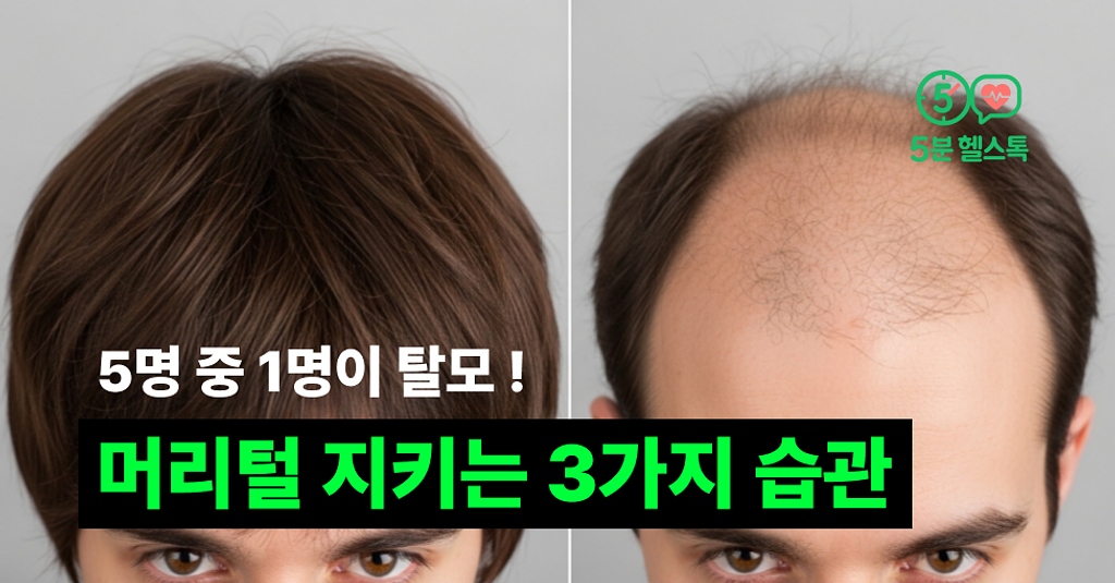 5명 중 1명이 탈모! 머리털 지키는 3가지 습관의 썸네일 이미지