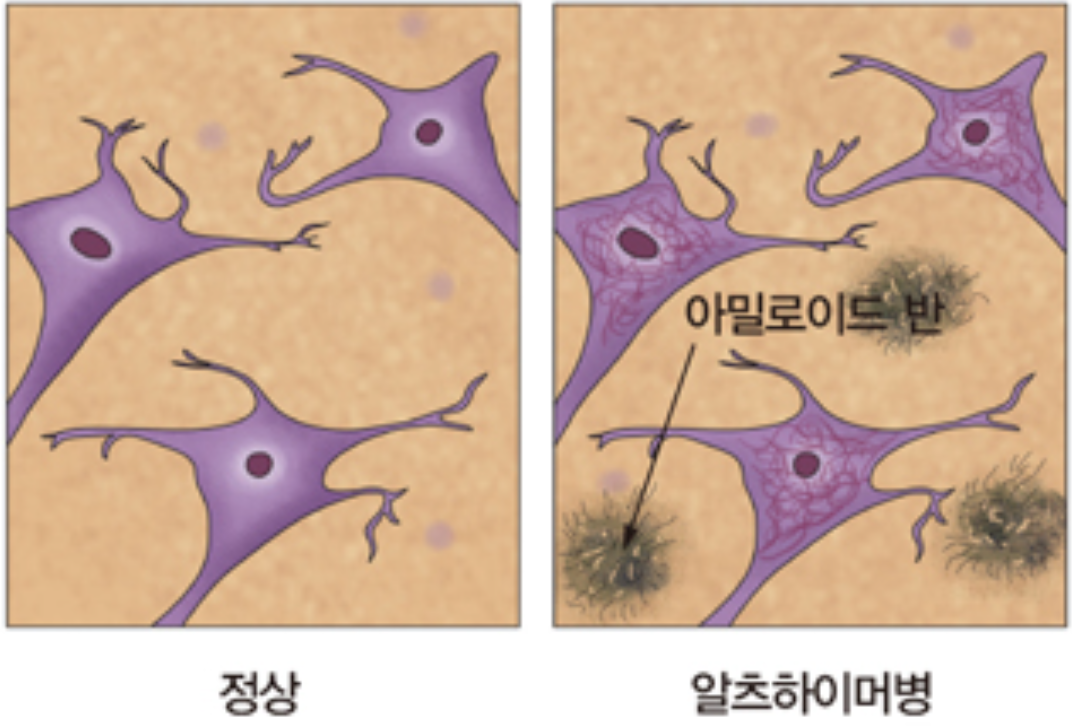 알츠하이머병 환자의 아밀로이드 플라크에 작용하는 Donanemab의 능력의 썸네일 이미지