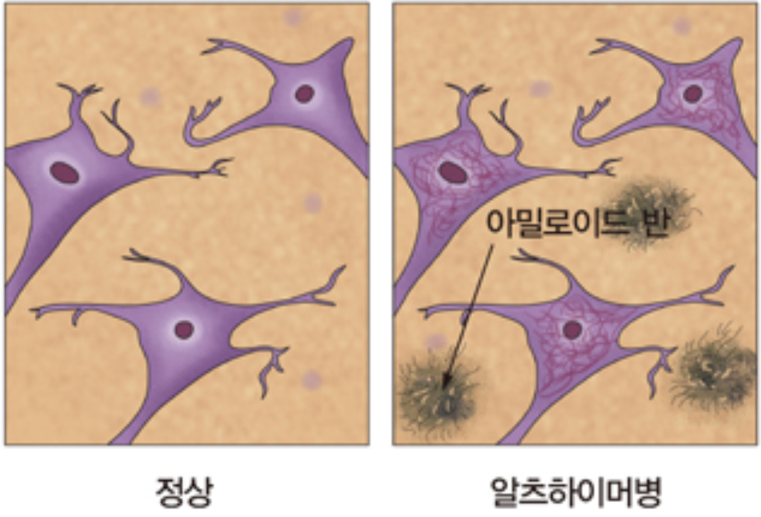 알츠하이머