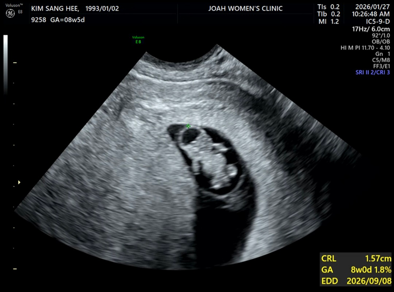 우주인 같던 아가 약 9주차쯤!