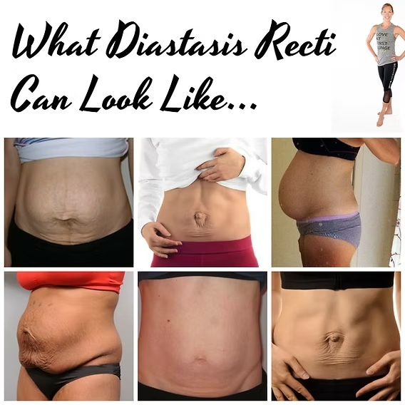 복직근이개를 임신배로 부르기로 한 이유의 썸네일 이미지