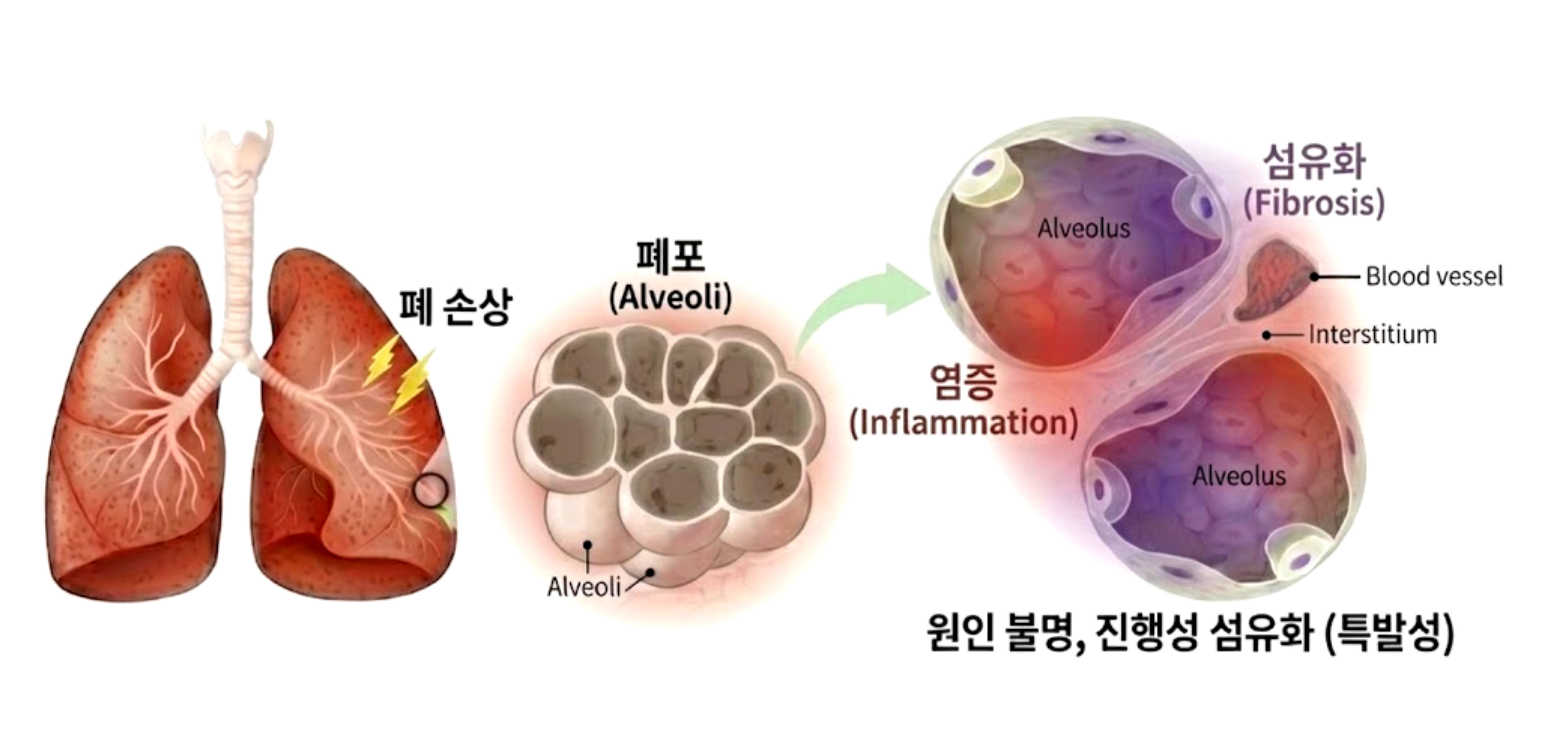Adapted from. Nerandomilast mechanism of action.Boehringer Ingelheim HCP Portal.