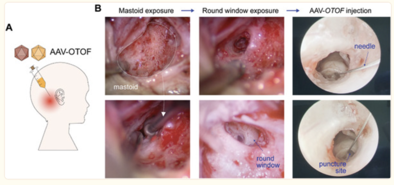 출처 : AAV-Mediated Gene Therapy Restores Hearing in Patients with DFNB9 Deafness