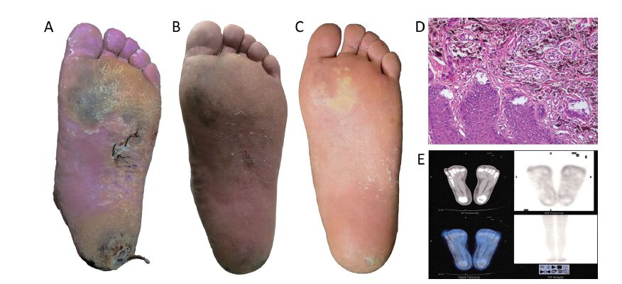 BNCT 치료 후Yong Z, Song Z, Zhou Y, Liu T, Zhang Z, Zhao Y, Chen Y, Jin C, Chen X, Lu J, Han R, Li P, Sun X, Wang G, Shi G, Zhu S. Boron neutron capture therapy for malignant melanoma: first clinical case report in China. Chin J Cancer Res 2016;28(6):634-640. doi: 10.21147/j.issn.1000-9604.2016.06.10