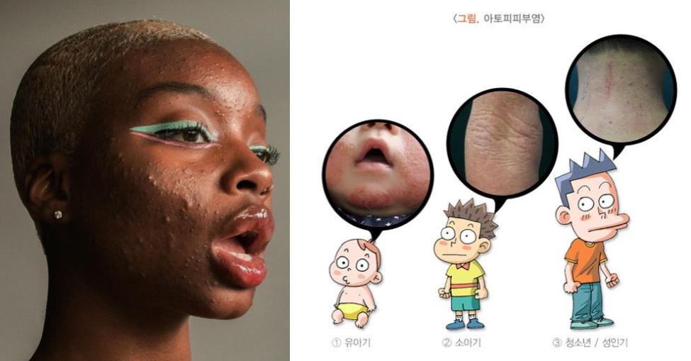 (좌- 낭포성 여드름 / 우- 습진(아토피피부염/출처: 질병관리청 국가건강정보포털))