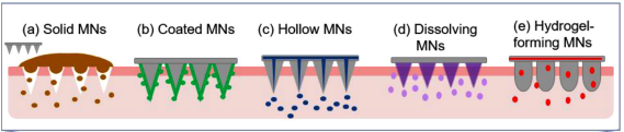 출처:  Yang, D., Chen, M., Sun, Y., Jin, Y., Lu, C., Pan, X., Quan, G., & Wu, C. (2021, February). Microneedle-mediated transdermal drug delivery for treating diverse skin diseases. Acta Biomaterialia, 121, 119–133. 