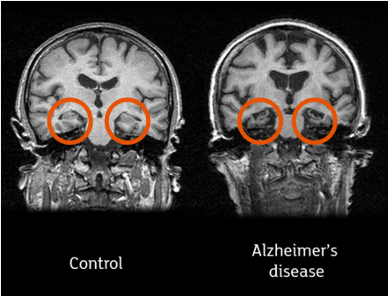 알츠하이머 진단에 효과적인 CSF biomarker의 썸네일 이미지