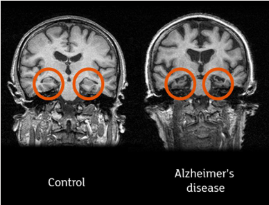 알츠하이머 환자의 경우, 정상인과 비교했을 때 뇌의 핵심 기억 중추인 해마가 위축되어 있는 모습을 확인할 수 있어요