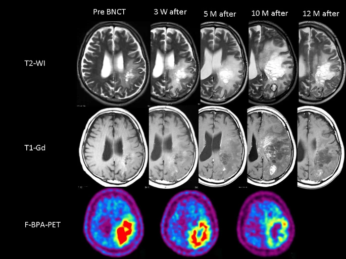 Miyatake, SI., Kawabata, S., Hiramatsu, R. et al. Boron neutron capture therapy with bevacizumab may prolong the survival of recurrent malignant glioma patients: four cases. Radiat Oncol9, 6 (2014). https://doi.org/10.1186/1748-717X-9-6