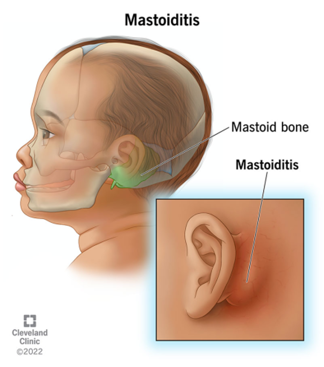 https://my.clevelandclinic.org/-/scassets/Images/org/health/articles/24469-mastoiditis