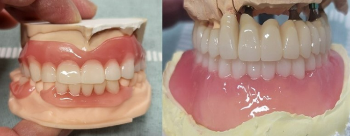 3D프린터용 레진 'FLEXIBLE' 사진 / 덴티스 제공