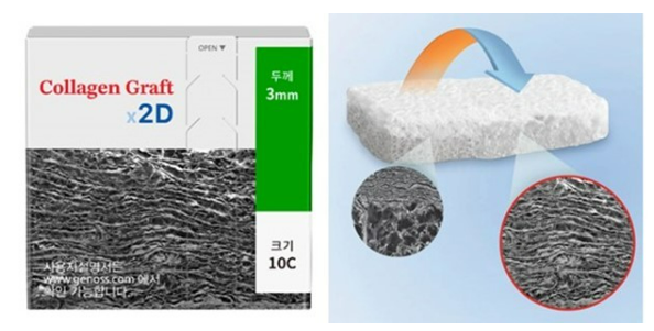 'Collagen Graft X2D' 사진 / 덴티움 제공