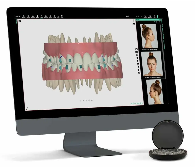 Smilers 투명 교정기 시스템 참조 사진 / 영국 헨리세인 제공